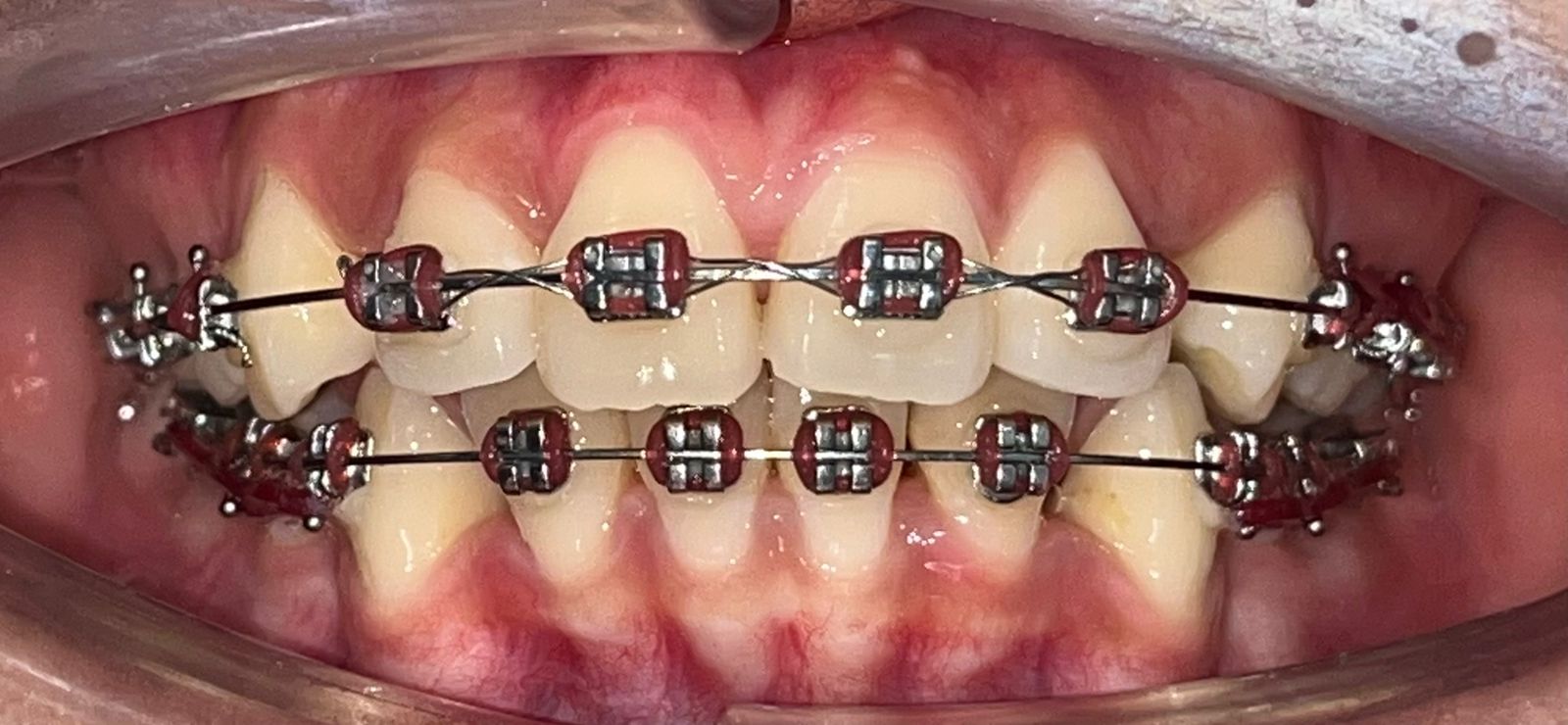 Tren Perawatan Ortodonti Meningkat di Gorontalo: Gigi Rapi untuk Kesehatan, Bukan Sekadar Gaya